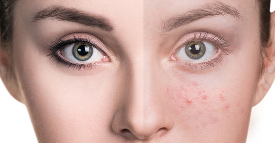 Before and after Image of acne purifying facial