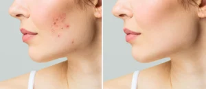 Acne purifying facial before and after images