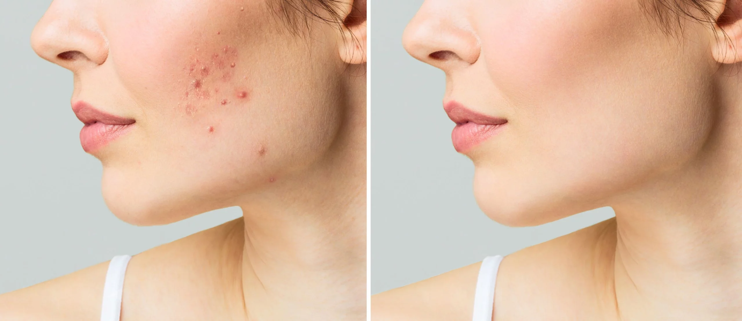 Acne purifying facial before and after images
